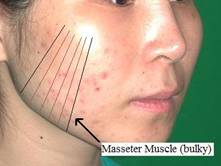 Enlarged Masseter Muscle Causes a Widened Appearance to the Lower Face